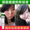 祛痘yzzj消炎粉刺青春痘精油面膜祛痘膏去痘印男士祛痘产品前五强